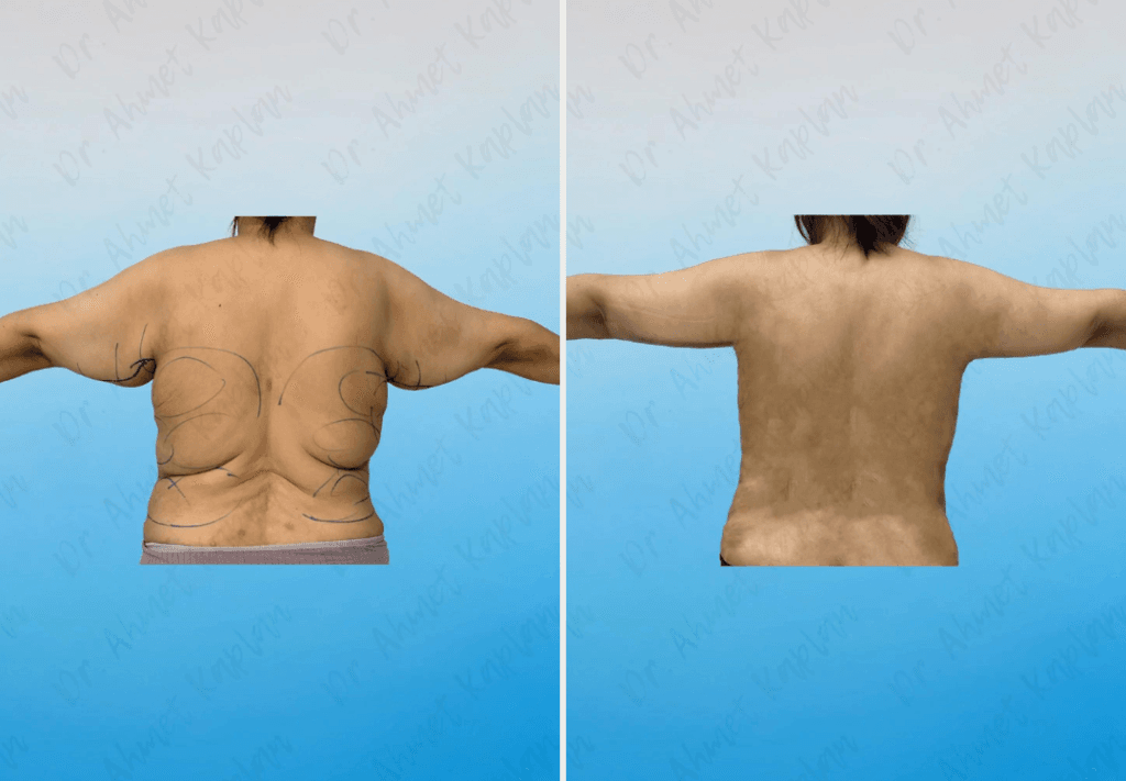 Arm Lift Surgery in Turkey