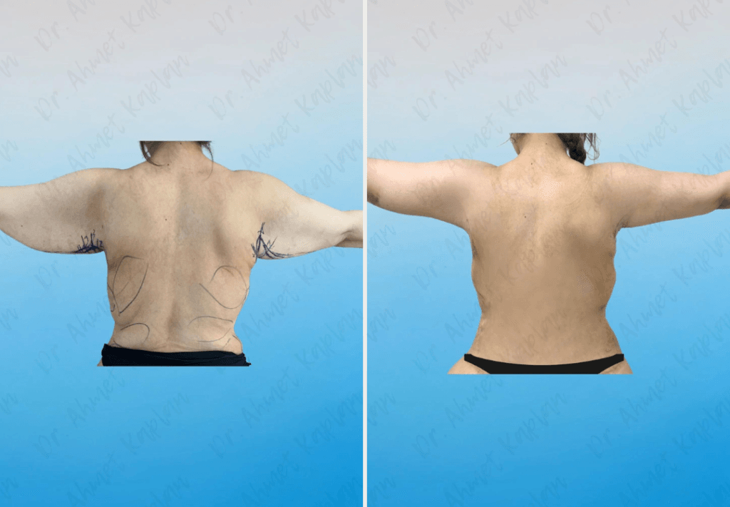 Arm Lift Surgery in Turkey