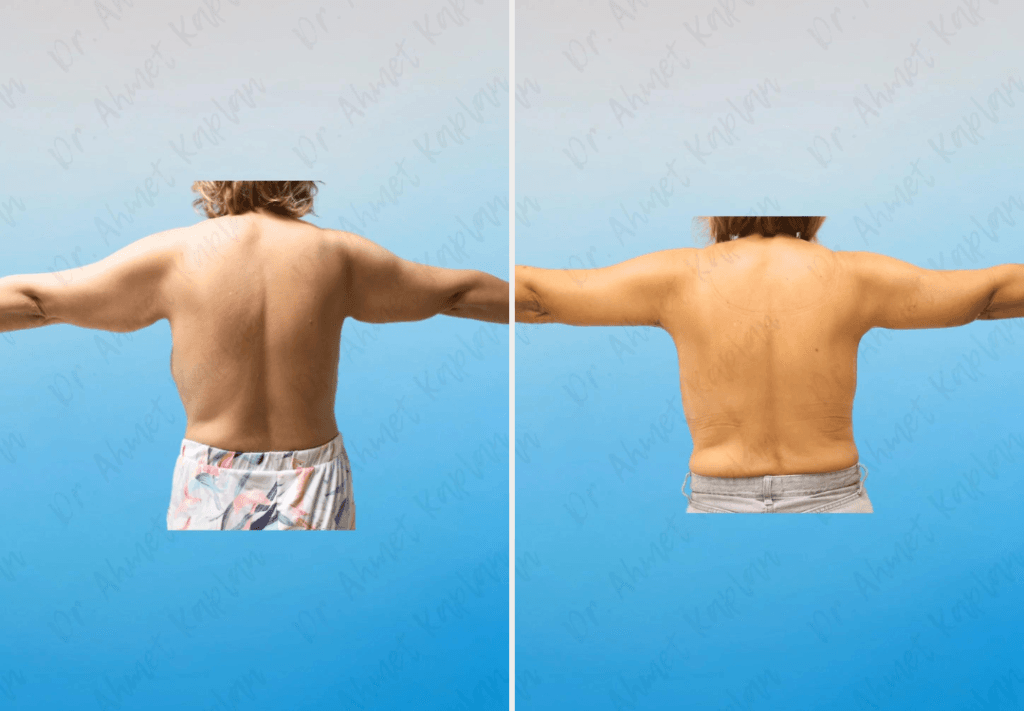 Arm Lift Surgery in Turkey