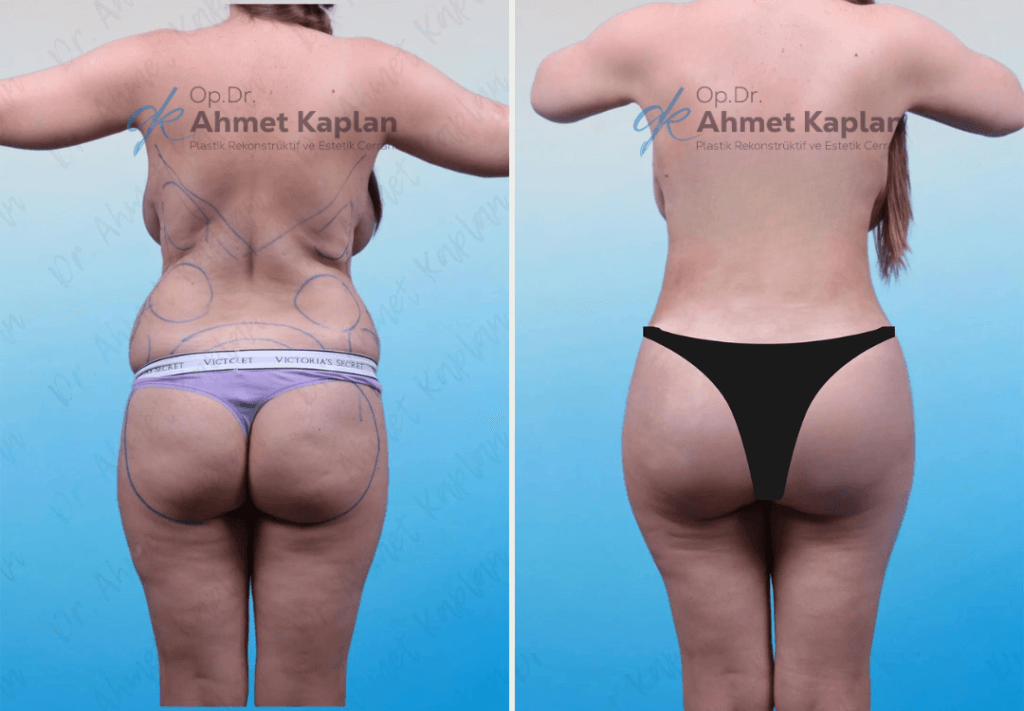 BBL in Turkey (Brazilian Butt Lift)​ (11)