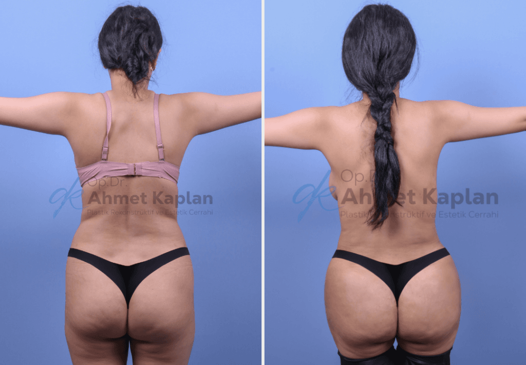 BBL in Turkey (Brazilian Butt Lift)​ (4)
