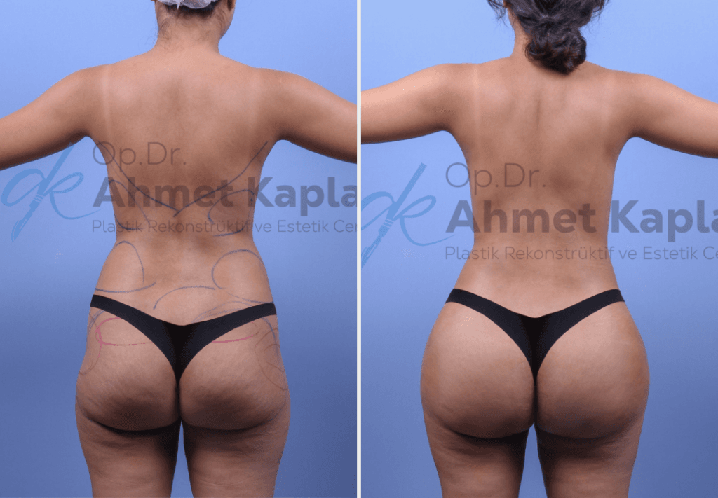 BBL in Turkey (Brazilian Butt Lift)​ (5)
