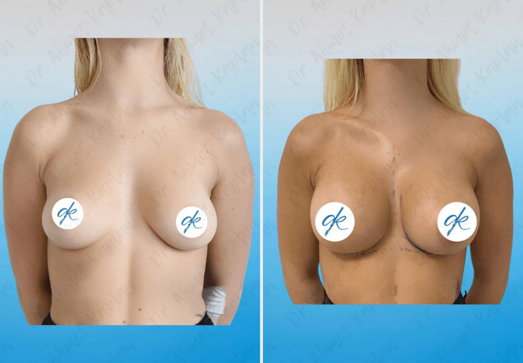 Breast Augmentation in Turkey