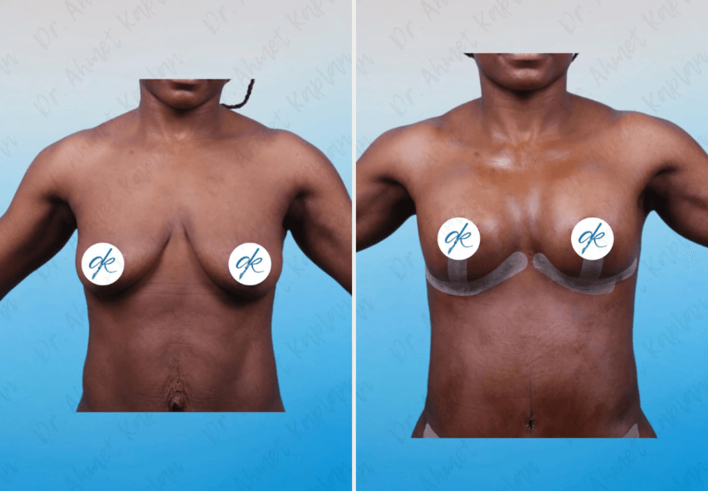 Breast Lift & Augmentation Surgery in Turkey