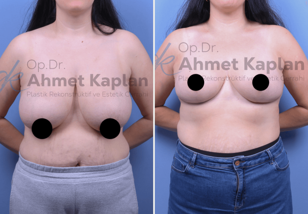 Breast Lift Surgery in Turkey