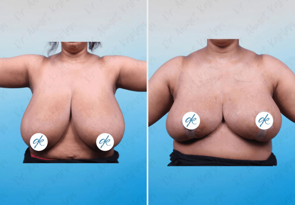 Breast Lift Surgery in Turkey