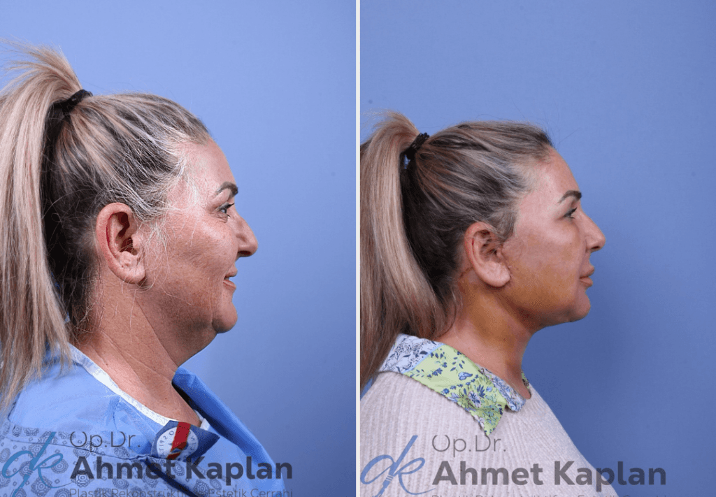 Face Lift Surgery in Turkey