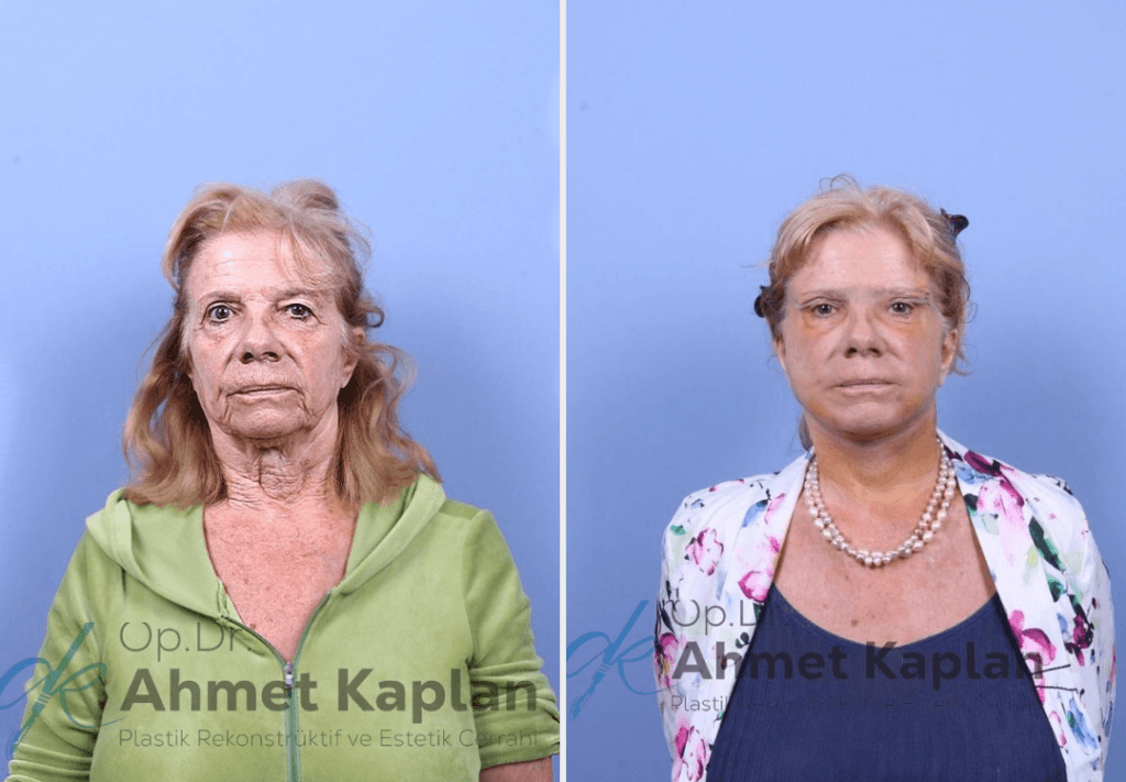 Face Lift Surgery in Turkey