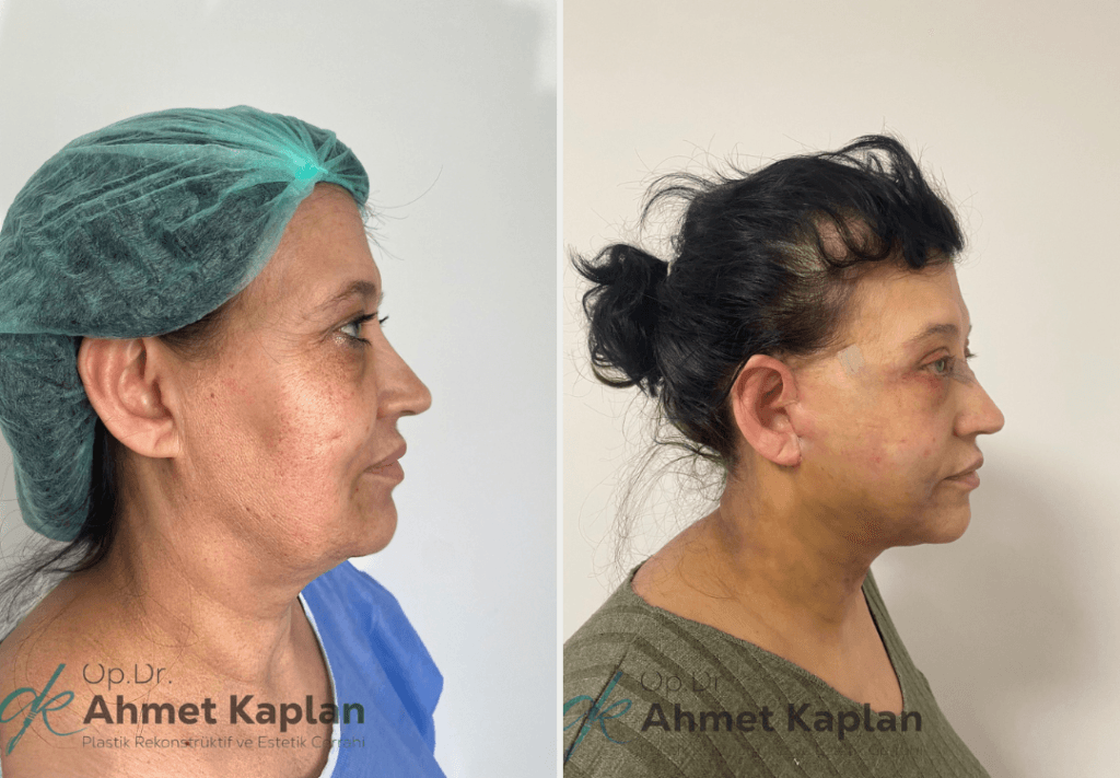 Face Lift Surgery in Turkey