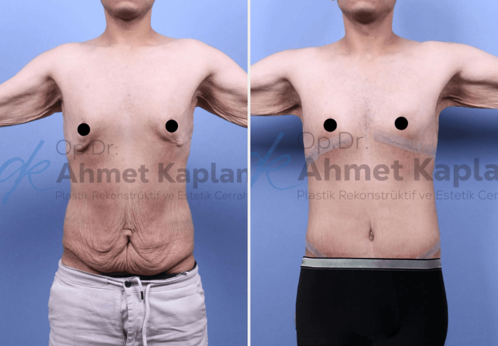 Male Aesthetics in Turkey