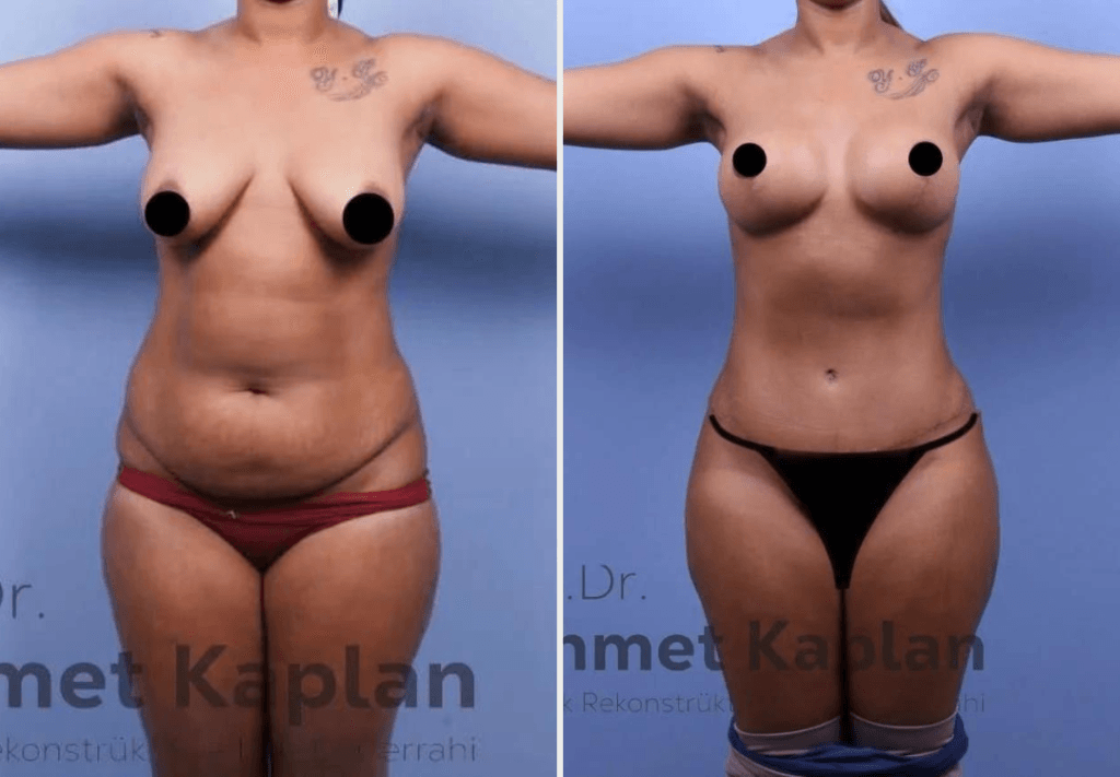 Mommy Makeover in Turkey (2)