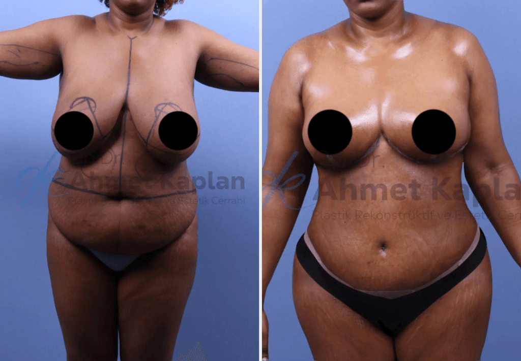 Mommy Makeover in Turkey (7)