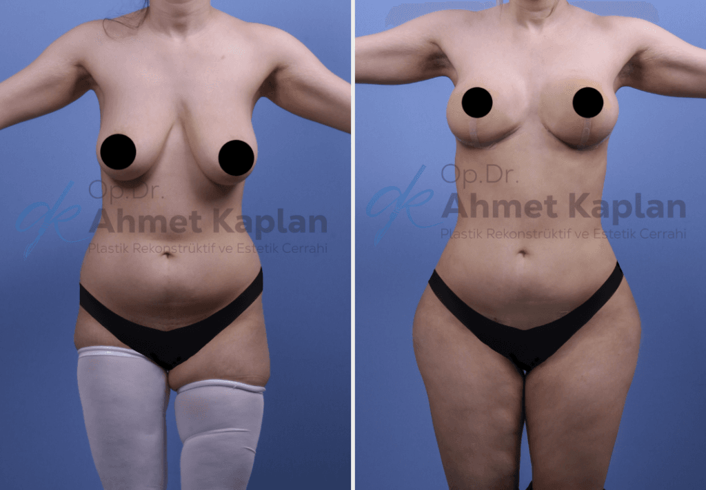 Mommy Makeover in Turkey (8)