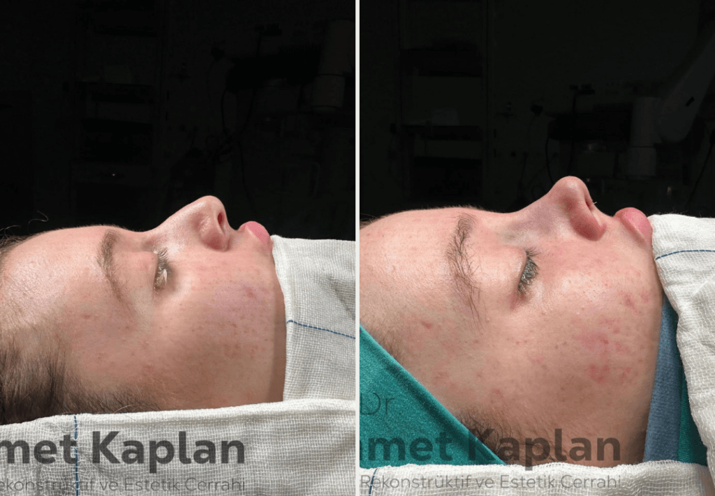 Rhinoplasty in Turkey