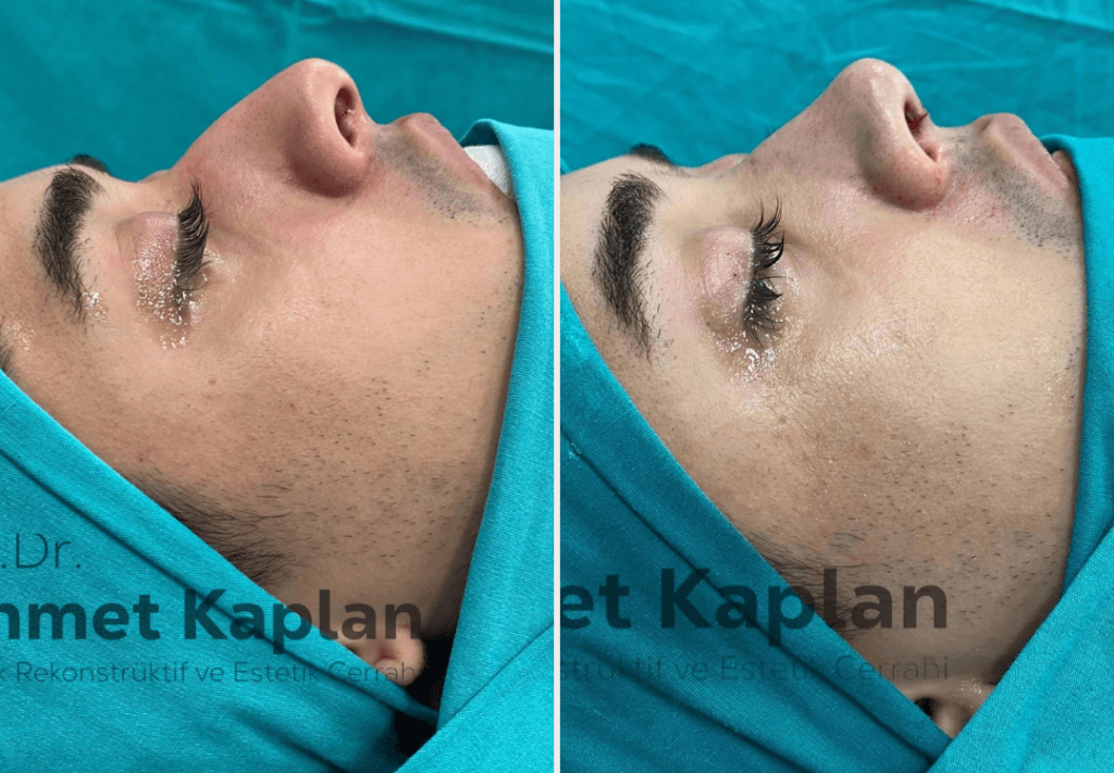 Rhinoplasty in Turkey