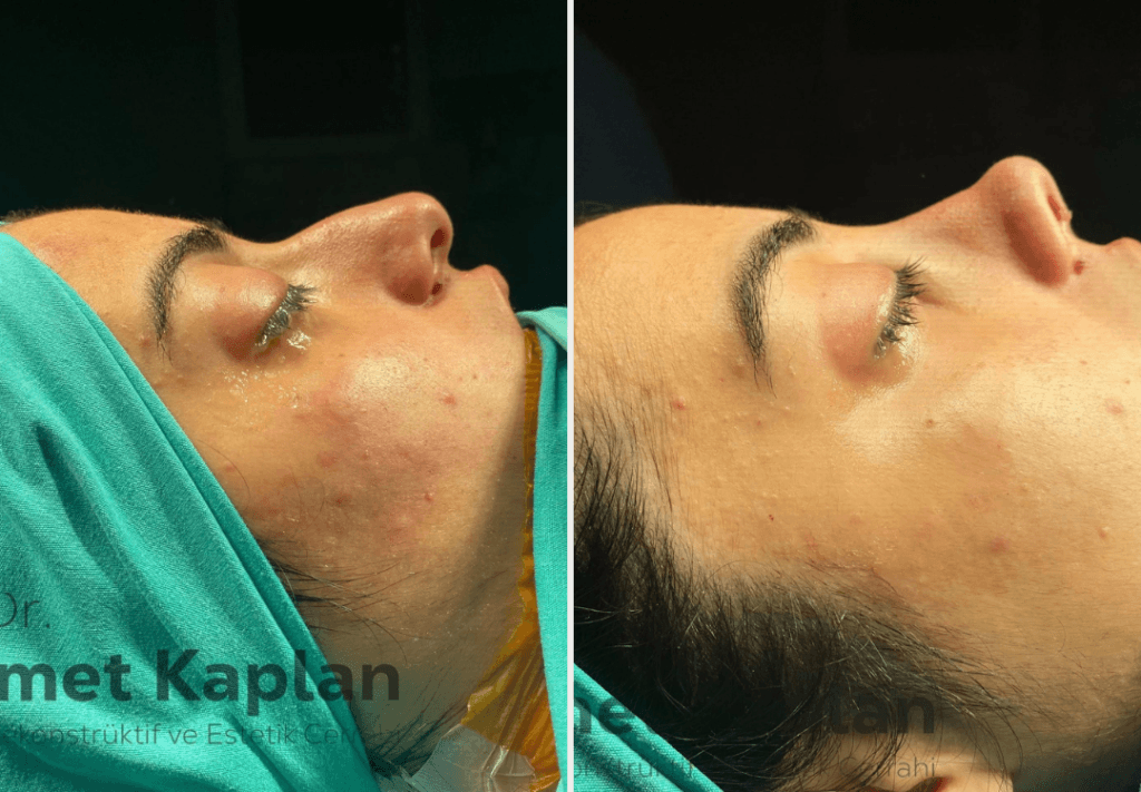 Rhinoplasty in Turkey