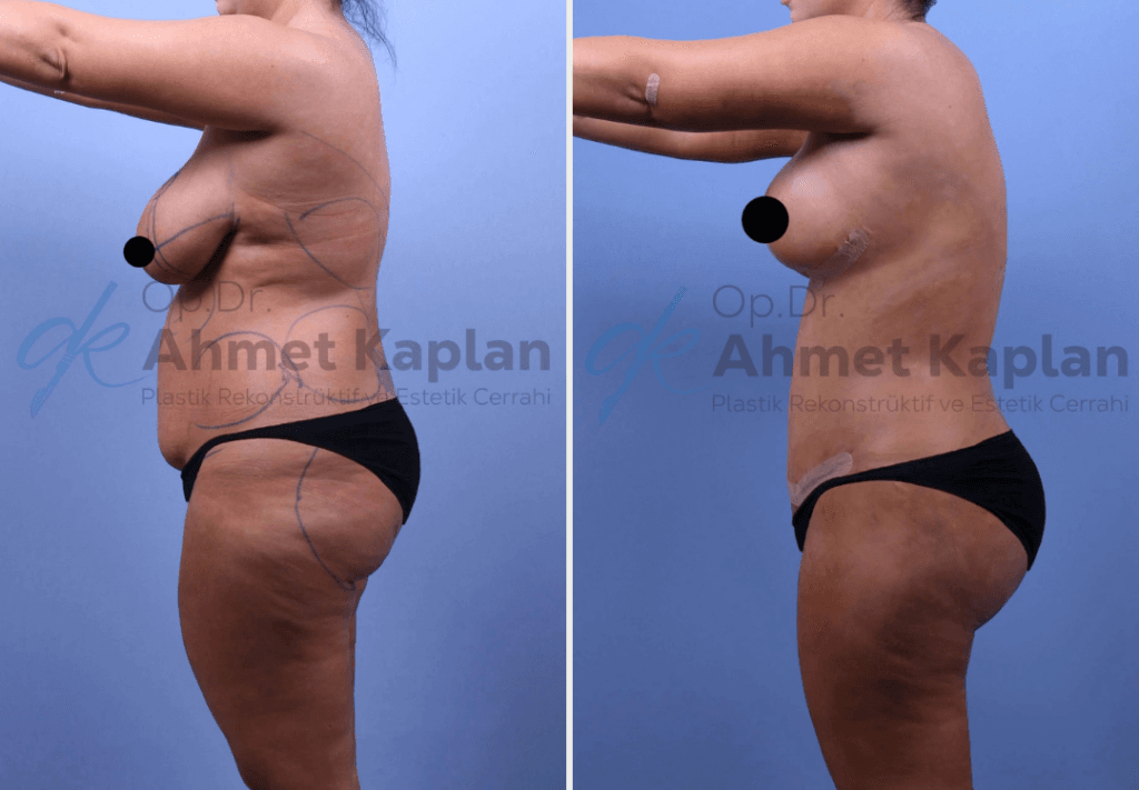 Tummy Tuck Surgery in Turkey (4)