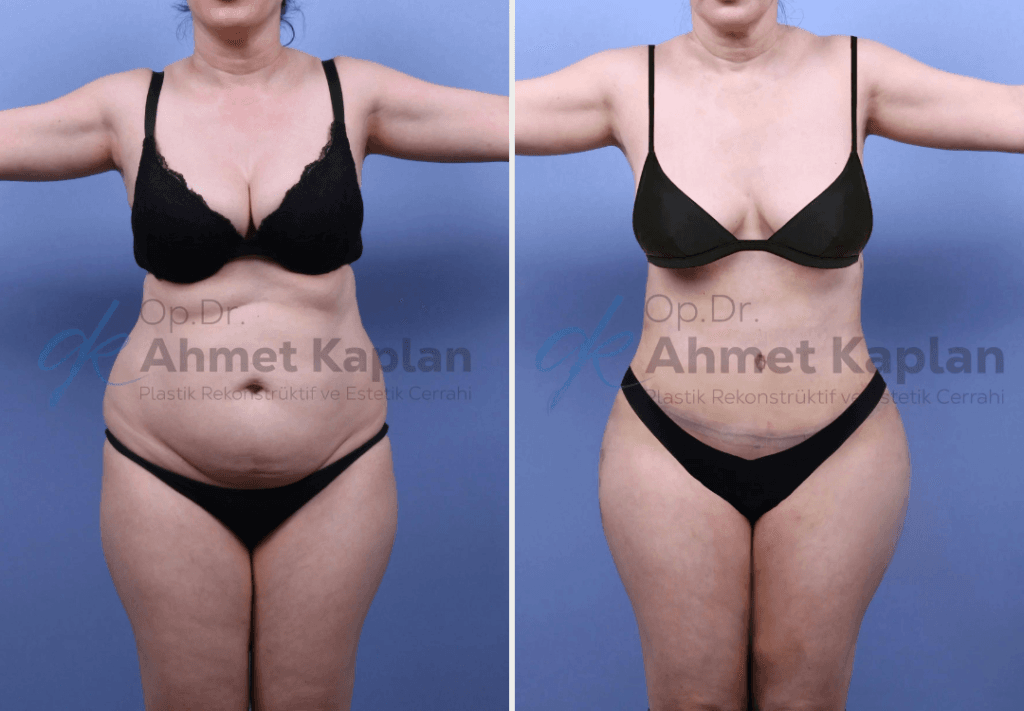 Tummy Tuck Surgery in Turkey (7)