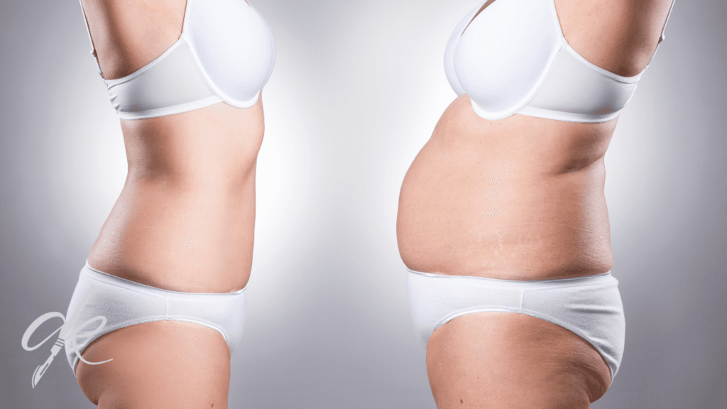 Liposuction nedir? Nasıl Yapılır?