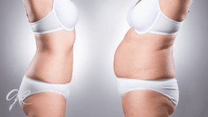 Liposuction nedir? Nasıl Yapılır?