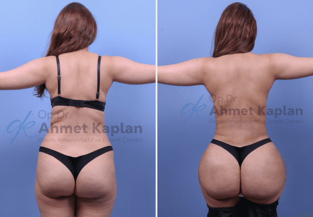 BBL in Turkey (Brazilian Butt Lift)​ (1)