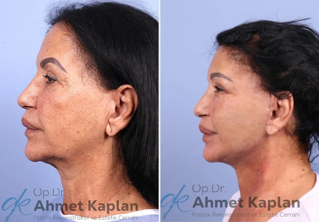 Face Lift Surgery in Turkey