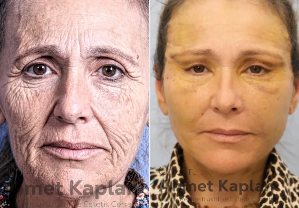 Face Lift Surgery in Turkey