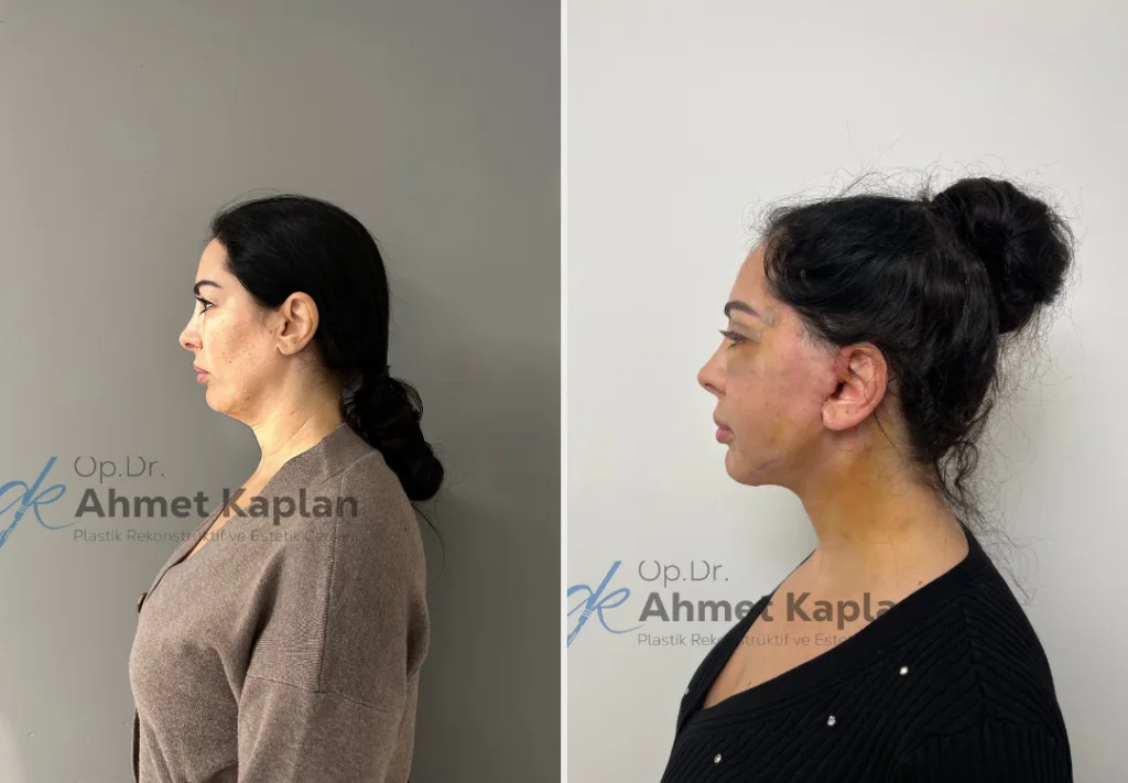 Face Lift Surgery in Turkey