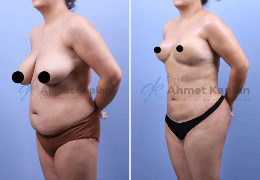 Mommy Makeover in Turkey (1)
