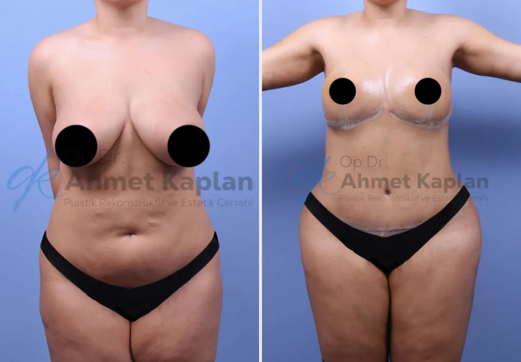 Mommy Makeover in Turkey (6)