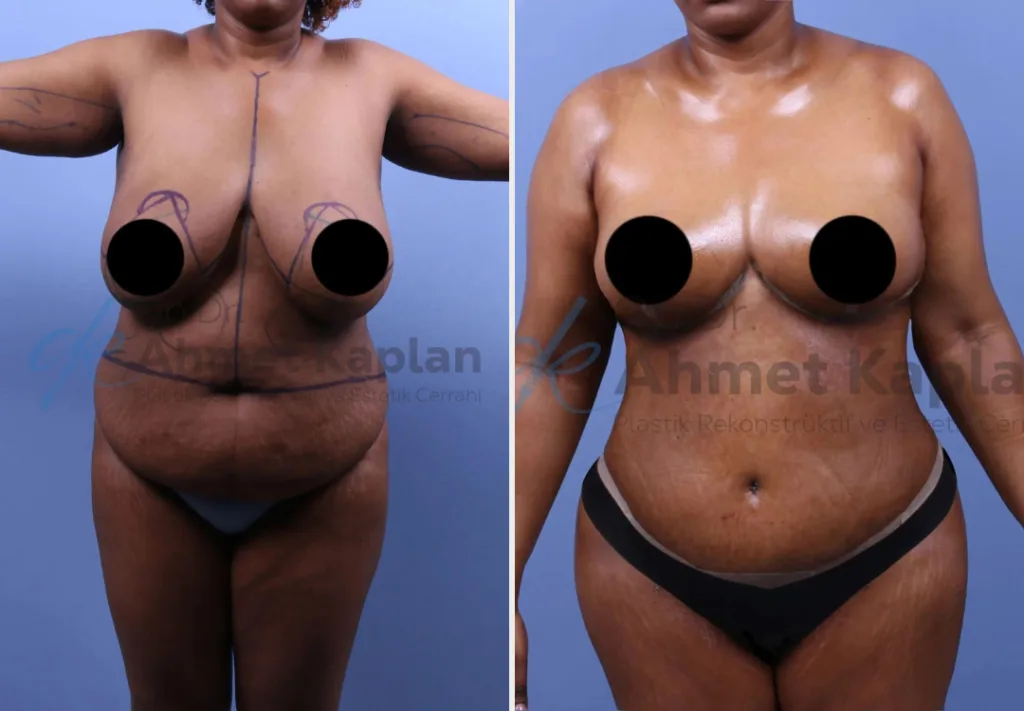 Mommy Makeover in Turkey (7)