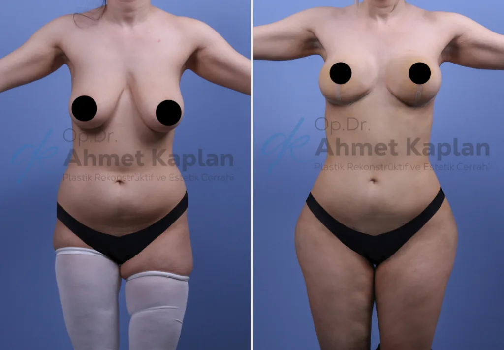 Mommy Makeover in Turkey (8)
