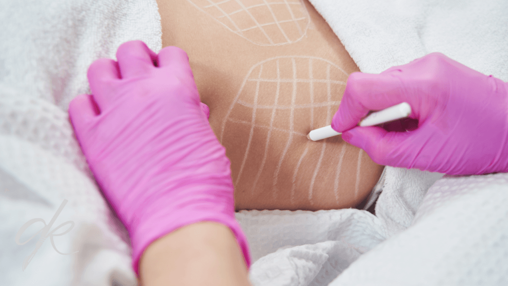 What is the recovery process after abdominoplasty?