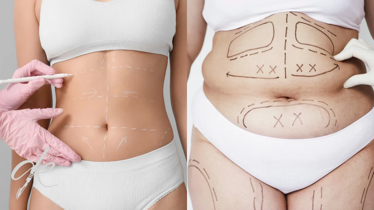 The Differences Between Tummy Tuck and Liposuction