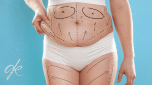 How long should a compression garment be worn after a tummy tuck?