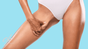 J Plasma Thigh Lift Surgery