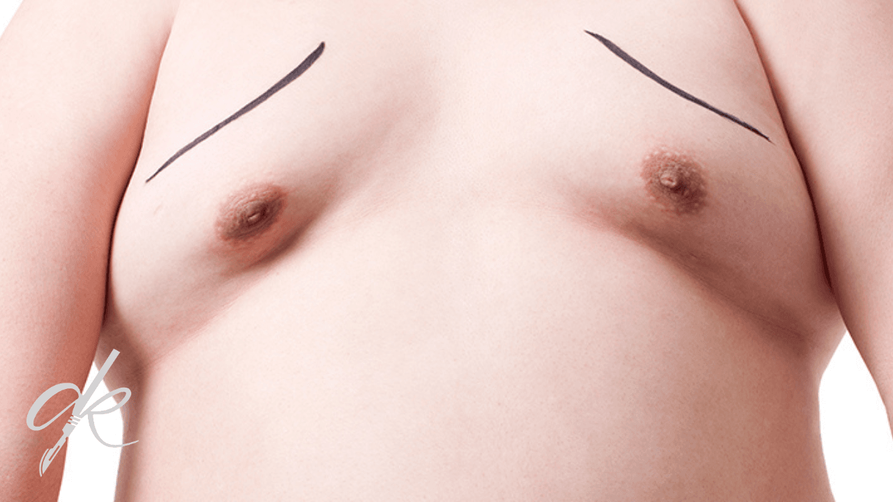 What Is the Difference Between Gynecomastia and Stubborn Fat?