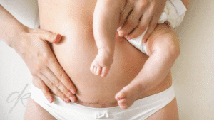Is Mommy Makeover Permanent