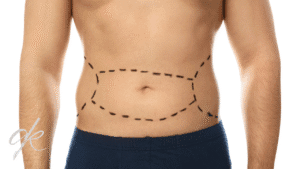 When Are Stitches Removed After a Tummy Tuck?