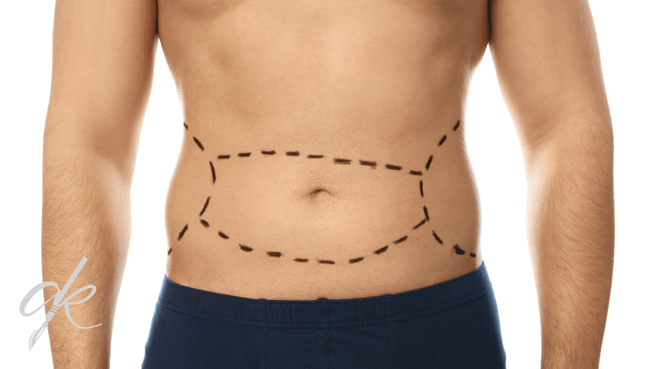 When Are Stitches Removed After a Tummy Tuck?