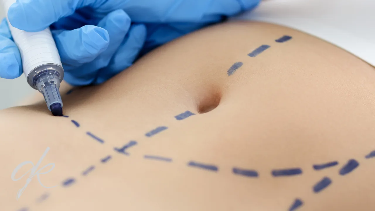 Sexual intercourse after abdominoplasty