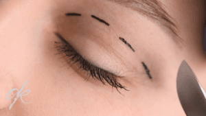 Put an End to Tired Expression with Eyelid Surgery